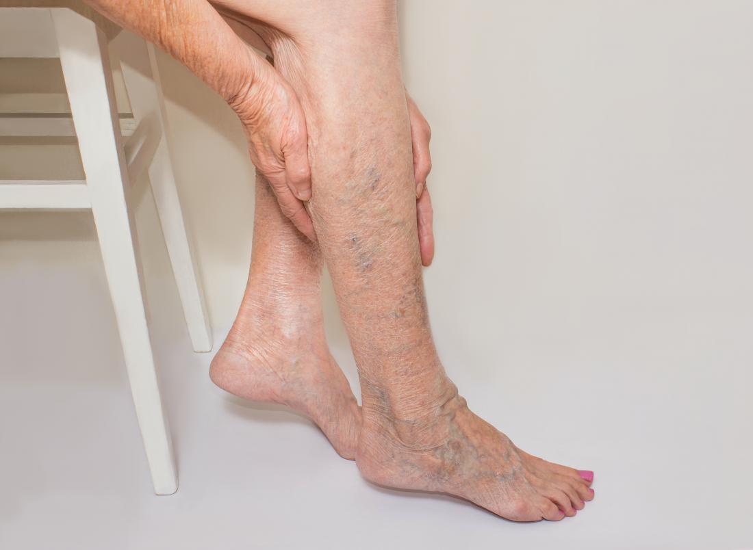 are-you-suffering-from-veins-damage-in-your-leg-know-the-cause-before